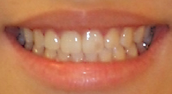 Close up of smile after orthodontic treatment