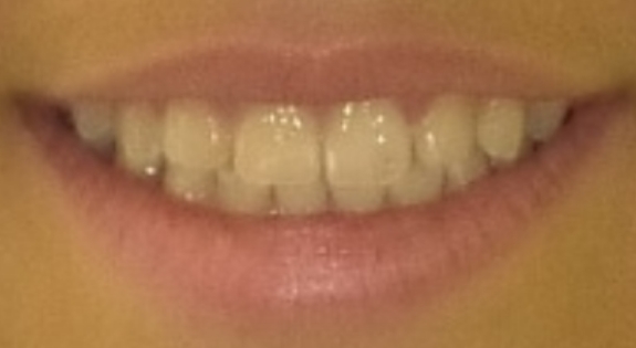 Close up of smile before orthodontic treatment
