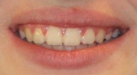 Close up of smile with evenly spaced teeth