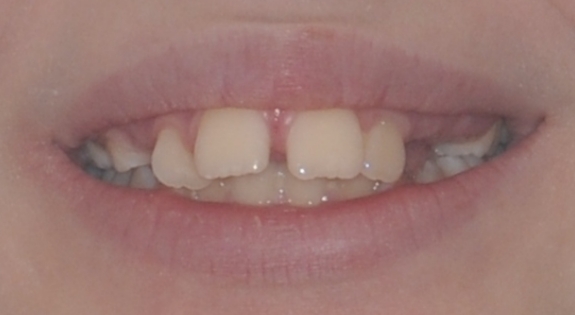 Close up of smile with crowded and gapped teeth
