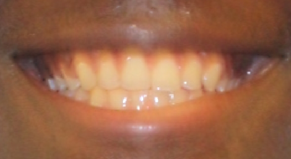 Close up of smile with well aligned teeth