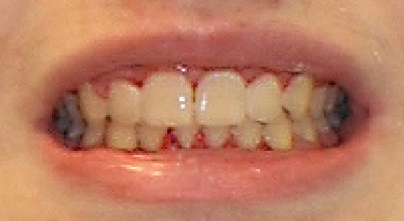 Close up of smile after correcting crowded teeth