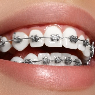 Close up of smile with self ligating braces